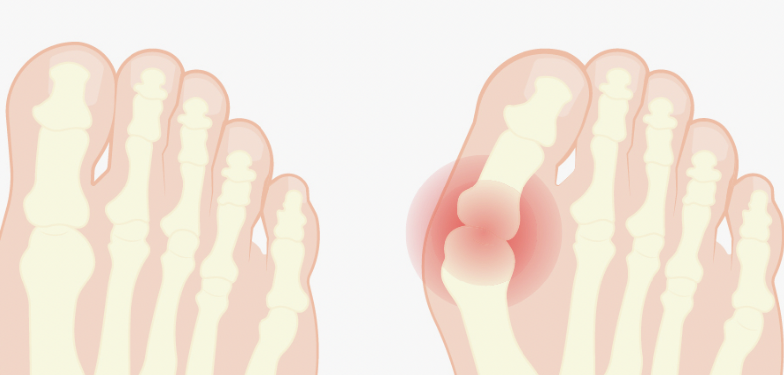 Bagaimana Bahan Elastis Melindungi Kaki dengan Kondisi Valgus